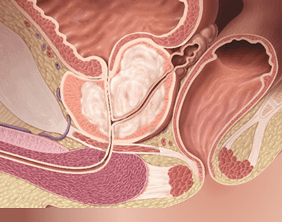 leaflat thumbnail pembesaran prostat jinak bph