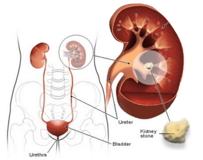 leaflat thumbnail penyakit batu ginjal